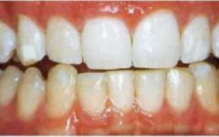 Как избавиться от белых и желтых пятен на зубах: эффективные средства по удалению точек и полос