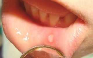 Во рту у взрослого появилась белая язвочка: что делать и как лечить болячку на щеке с внутренней стороны?