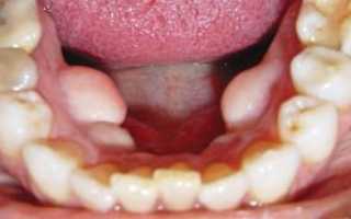 Экзостоз — осложнение после удаления зуба: как избавиться от костного нароста на десне?