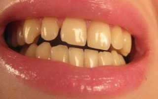 Почему желтеет эмаль: причины желтых зубов у взрослых, что делать и как их отбелить?