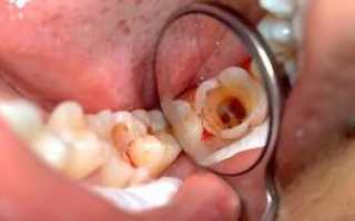Пульпит: лечение зуба в домашних условиях — как снять боль народными средствами?