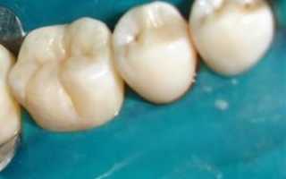 Что такое герметизация или запечатывание фиссур молочных зубов у детей: все за и против процедуры