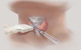 Для чего проводят пункционную биопсию ТАБ щитовидной железы под контролем УЗИ аппарата?