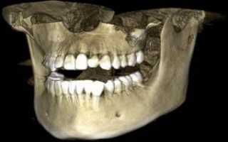 Что такое КТ нижней и верхней челюсти, и зачем в стоматологии делают рентгеновский снимок зубов в 3d?