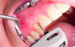 Как с зубов снимают коронки или мосты из металлокерамики: удаление в домашних условиях и на приеме у врача