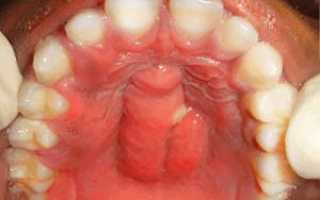 Симптомы периостита зуба с фото, лечение воспаления надкостницы нижней или верхней челюсти