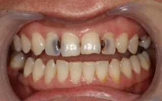Лечение и профилактика кариеса между зубами (передними или жевательными): фото до и после