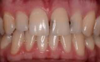 Что может быть с зубами, если не заниматься лечением кариеса — чем чревато заболевание у ребенка?