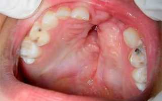 Девитальная и витальная ампутация при пульпите у детей: как происходит лечение зубов?