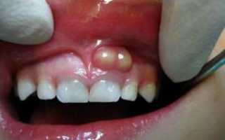 Киста на корне зуба: симптомы, удаление (резекция), терапевтическое лечение в домашних условиях