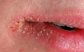 Грибок в уголках губ под названием молочница или кандидоз: симптомы и лечение белого налета у взрослых