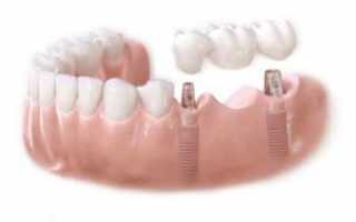 Как ставят зубные мосты: адгезивные, цельнолитые и штампованные типы мостовидных протезов с фото