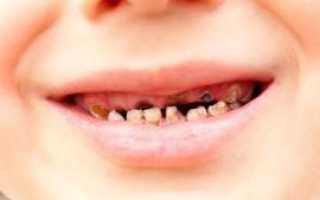Что делать, если зубы гниют до десны: чистка, удаление и последствия для организма