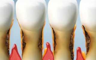 Как лечить запущенный или начальный пародонтоз: признаки на фото пародонтозных десен и зубов до и после лечения