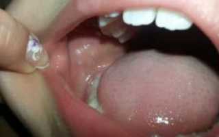 Белые язвочки у ребенка во рту: фото, причины появления болячек и лечение гнойничков в домашних условиях
