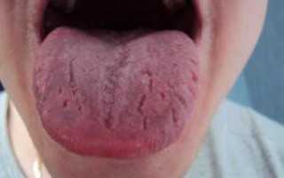 Симптомы и лечение дисбактериоза полости рта: как избавиться от бактерий на слизистой и устранить неприятный запах?