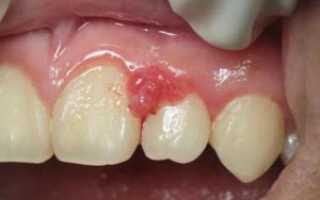 Можно ли удалять зубы при флюсе и обязательно ли это делать: особенности лечения