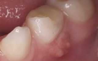 Антибиотики для лечения флюса десны в стоматологии: какие лекарства можно пить взрослому при периостите зуба?