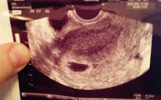 На каком сроке беременности и при каком ХГЧ видно эмбрион: достоверность исследования на первых неделях