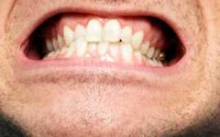 Почему сводит челюсти и зубы: причины тризма жевательной мускулатуры и мышц лица