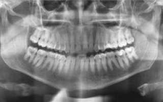 Понятие ТРГ-снимка зубов в ортодонтии, порядок проведения процедуры, расшифровка результатов