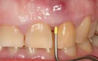 Как быстро снять отек на десне при зубном флюсе: эффективные средства для лечения и удаления опухоли