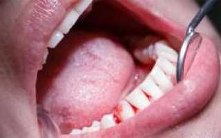 Лечение кровоточивости десен и запаха изо рта в домашних условиях народными средствами