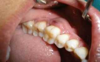 Развитие гнойного абсцесса зуба: симптомы с фото, лечение нарыва и возможные осложнения