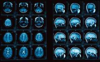 Расшифровка результатов МРТ-обследования головного мозга человека: нормы, описание снимков и заключение