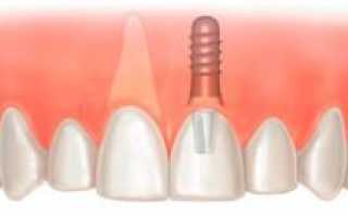 Этапы и последовательность протезирования зубов — хирургическая подготовка полости рта