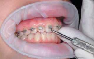 Больно ли снимать с зубов брекеты, можно ли это делать раньше срока и в домашних условиях?