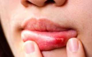Герпес у взрослого во рту — на десне и небе: лечение простуды на слизистой оболочке и фото симптомов