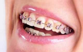 Могут ли зубы после снятия брекетов разъехаться и искривиться снова — что делать, если лечение не помогло?