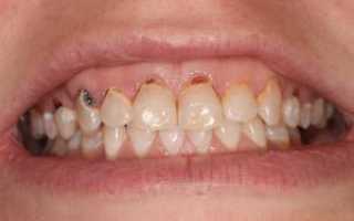 Почему у взрослого человека могут выпадать коренные зубы, что можно сделать?