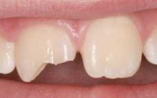 Что можно сделать, если зуб сломался, а корень остался в десне: полное удаление и восстановление