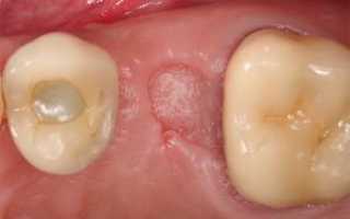 Что делать, если на месте удаленного зуба после появилось что-то белое в лунке: фото налета фибрина на десне