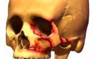 Классификация травм верхней челюсти — виды переломов по Лефор 1, 2 или 3