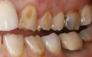 Причины и признаки эрозии зубной эмали, лечение наиболее распространенных форм заболевания