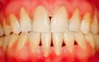 Как быстро укрепить десна и шатающиеся зубы в домашних условиях: забота о здоровье полости рта народными средствами
