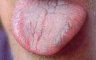 Фото складчатого языка, причины появления трещин и лечение кровоточивости в домашних условиях