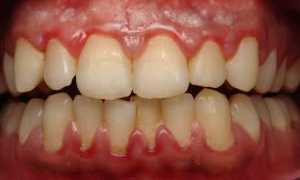 Что делать при воспалении полости рта (слизистой оболочки и языка): признаки и лечение заболеваний