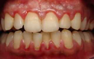 Что делать при воспалении полости рта (слизистой оболочки и языка): признаки и лечение заболеваний