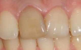 Можно ли отбелить передние зубы с пломбами и как это сделать в домашних условиях?