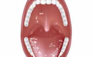 Щиплет и болит кончик языка: причины и лечение — почему возникает пощипывание и какое это может быть заболевание?