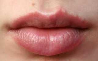 Почему у взрослого или ребенка может появиться аллергия на губах, как избавиться от отека?