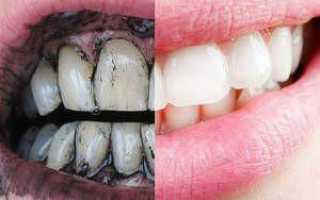 Как отбелить зубы при помощи активированного угля: фото до и после чистки в домашних условиях