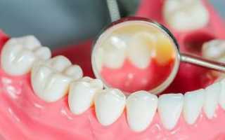 Почему под коронкой при надавливании болит зуб — что делать и как снять боль в домашних условиях?