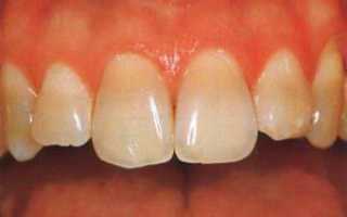 Отбеливание тетрациклиновых зубов: симптомы, диагностика и способы лечения с фото