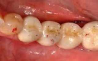 Черные или коричневые точки на зубах — что это: как избавиться от темных пятен и полосок в домашних условиях?