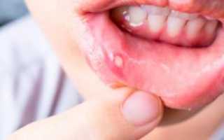 Как у детей и взрослых передается стоматит: заразно ли заболевание при поцелуе?